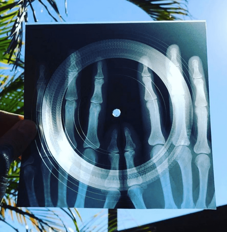 A lathe cut record done on an x-ray of two hands